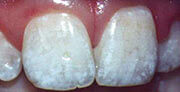 teeth with a mild case of fluorosis caused by fluoridated tap water